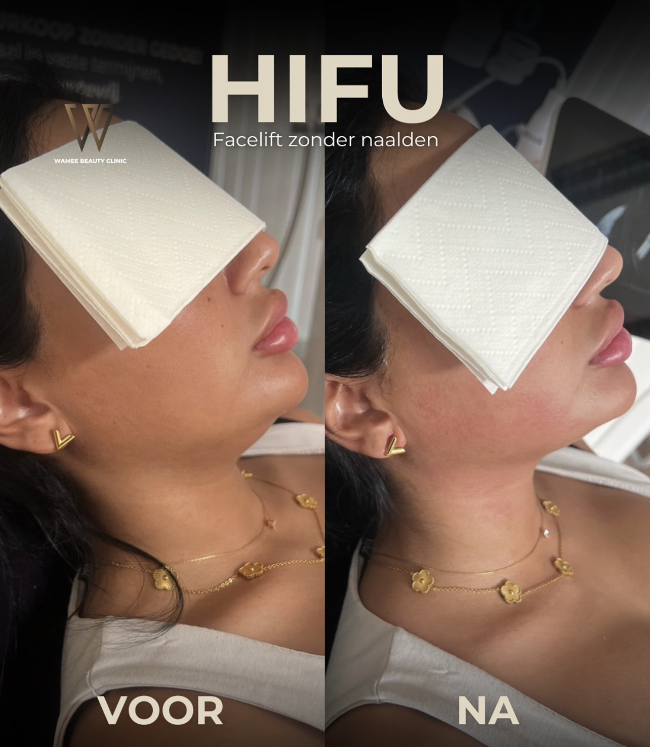 HIFU facelift — voor en na