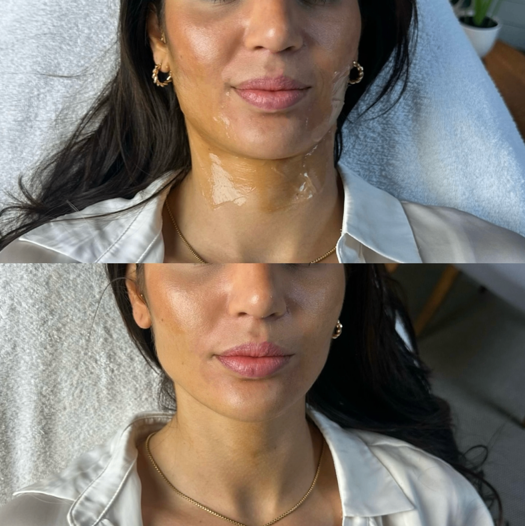 HIFU before & after resultaat